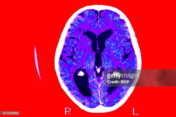 Scan Of The Brain Of A Patient Affected By Alzheimer's Disease Axial Section. Median Portion Of Dilated Third Ventricle. Symmetrical Dilation Of...