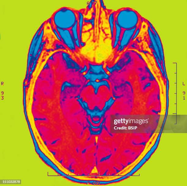 Mri Example Axial 248 Axial Mri Stock Photos, High-Res Pictures, and Images - Getty Images