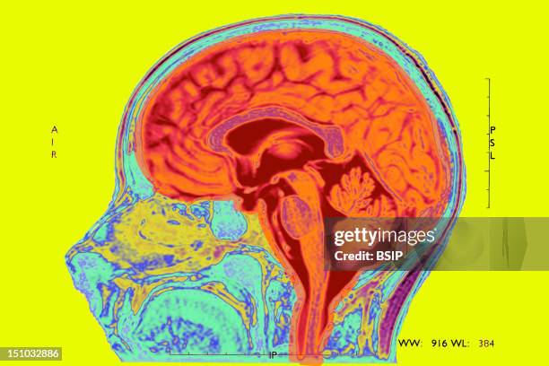 Sadgital Ridge 192 Sagittal Brain Stock Photos, High-Res Pictures, and Images - Getty ...