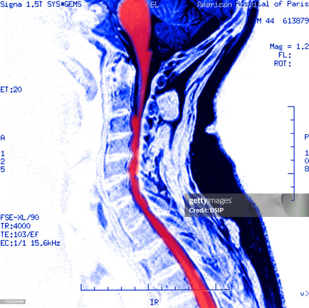 Cervical Osteoarthritis, Mri