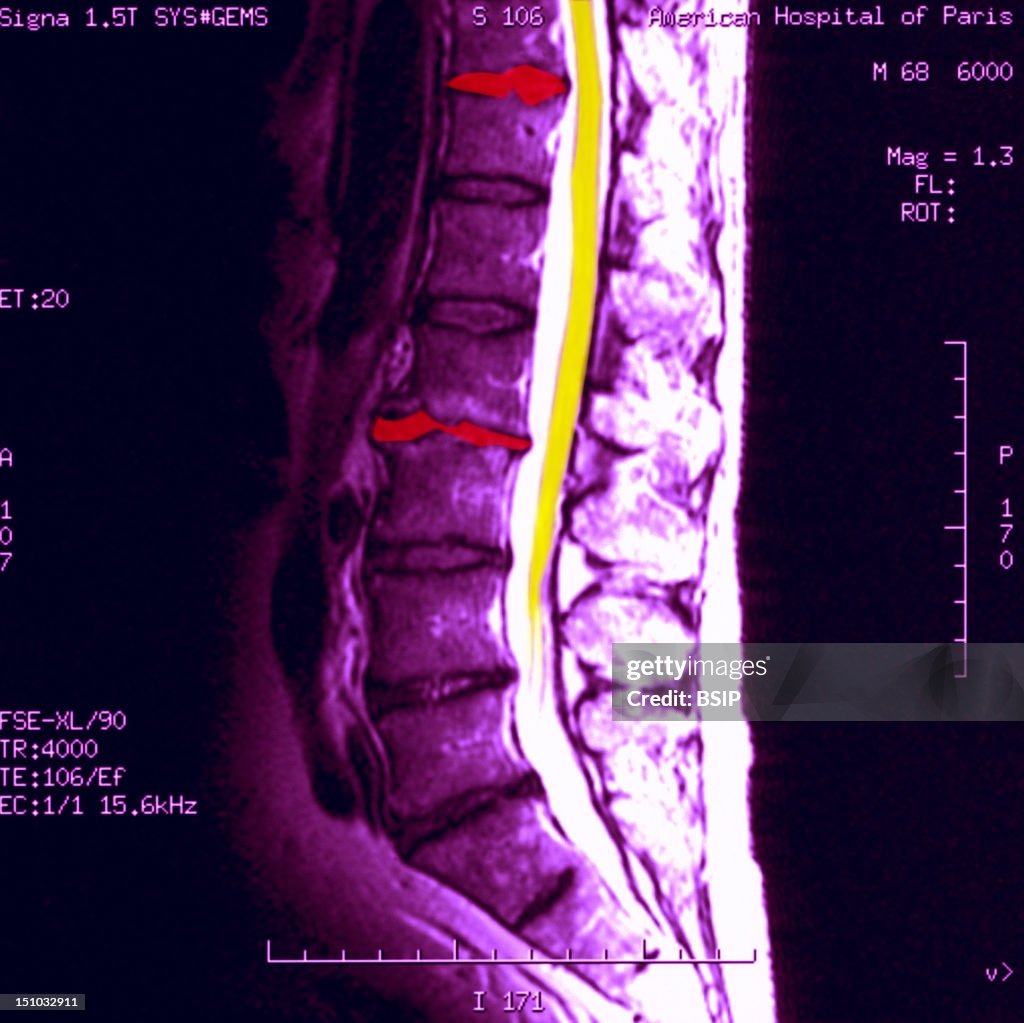 Vertebral Osteoarthritis, Mri