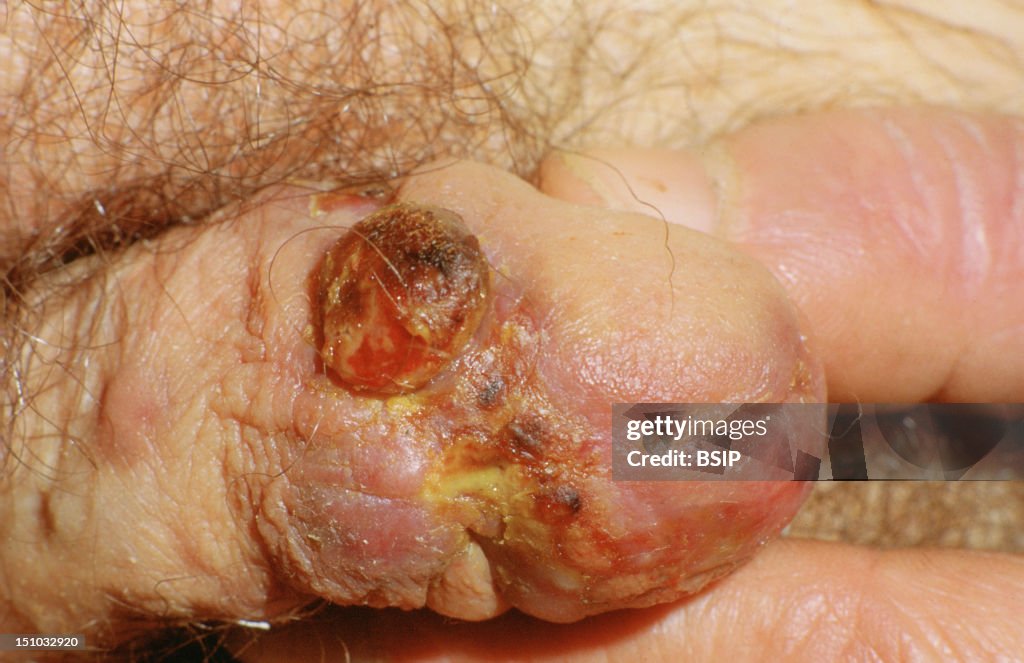 Kaposi'S Disease