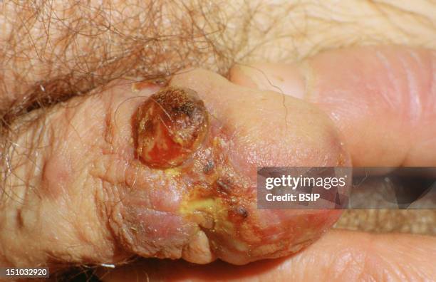 Kaposi's Disease