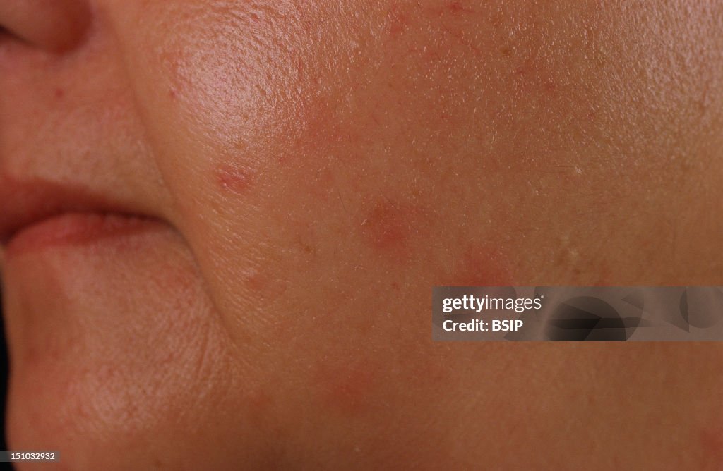 Polymorphous Light Eruption News Photo - Getty Images