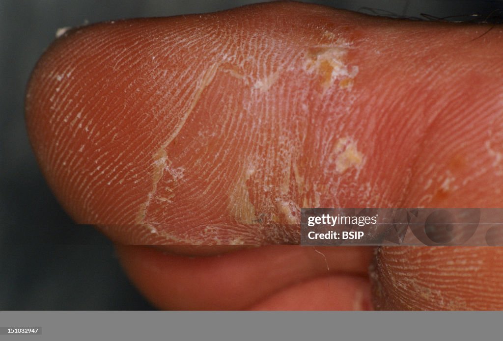 Desquamation Of The Skin