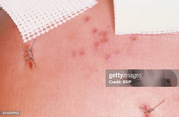 Prugio Rash Prurigo Photos and Premium High Res Pictures - Getty Images