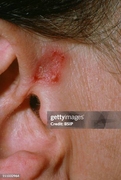 Cutaneous 157 Cutaneous Lupus Stock Photos, High-Res Pictures, and Images - Getty ...