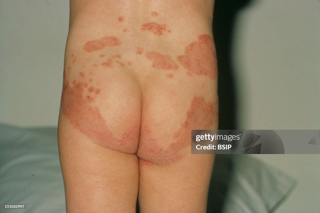 Psoriasis