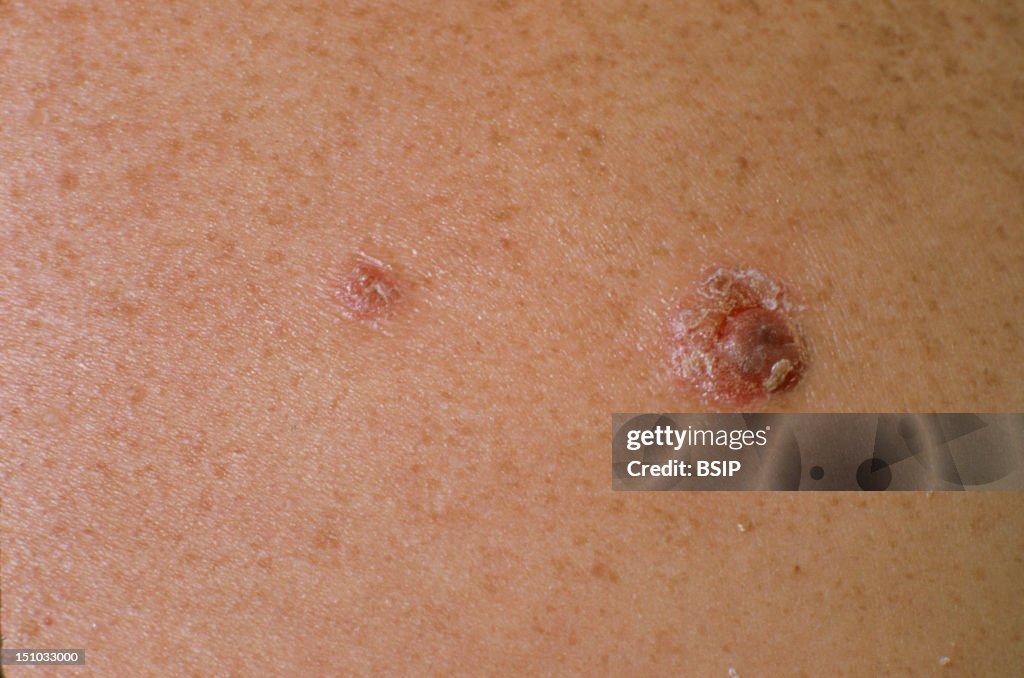 Psoriasis