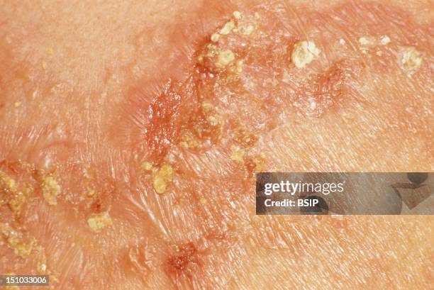 Pimphgus Rash Pemphigus Photos and Premium High Res Pictures - Getty Images