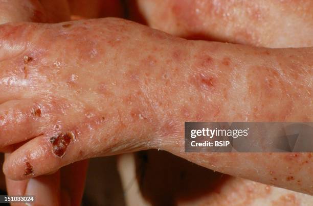 Candidal Granuloma, Also Called Monilial Granuloma.