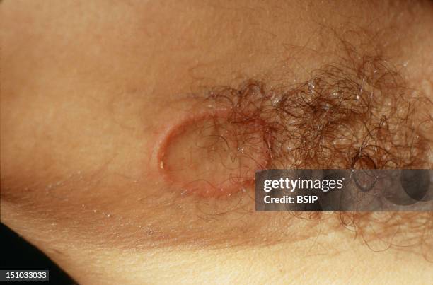 Microsporum Canis. Dermatophyte Mycosis At Armpit.