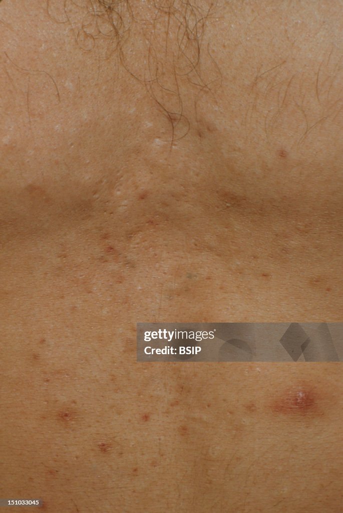 Sebaceous Cyst