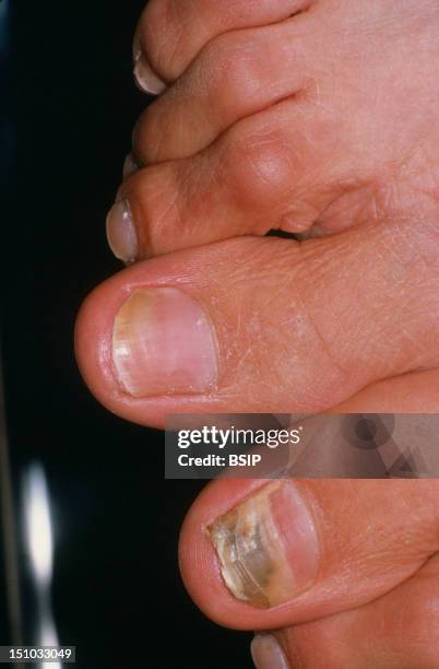 Nail Mycosis.