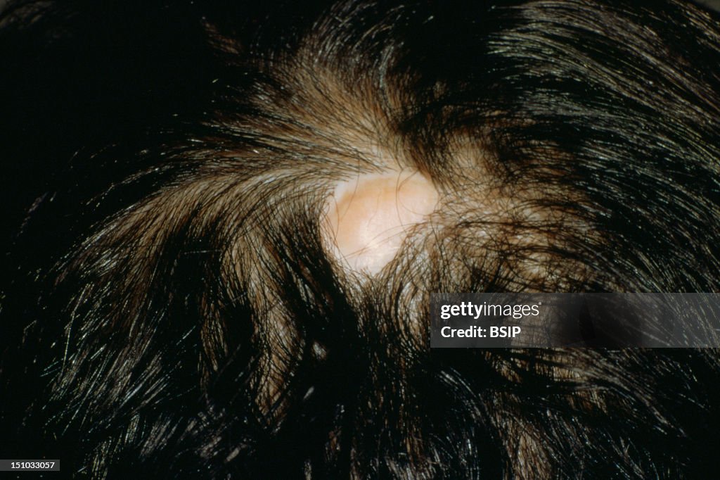 Sebaceous Birthmark Jadassohn's Sebaceous Nevus. News Photo - Getty Images