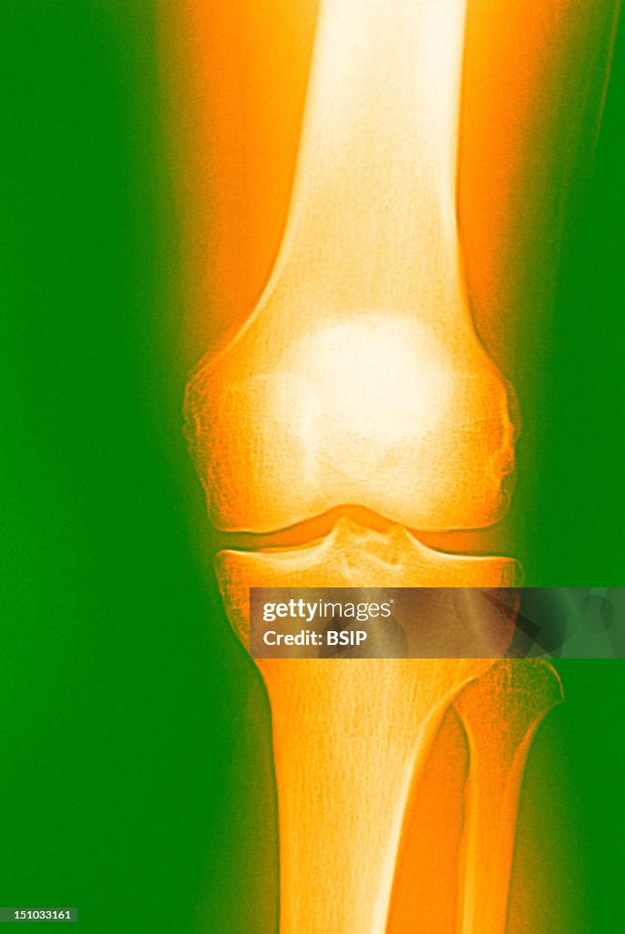 Knee, X-Ray