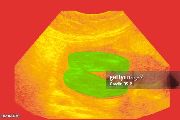 Legs Of A 22 Week Old Fetus Ultrasound. We Can See That It Is A Girl We Can See The Vaginal Labia Between The Legs.