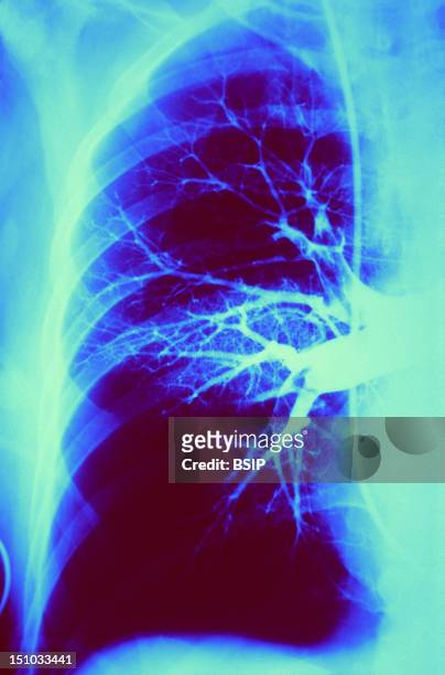 Pulmonary Embolism, X Ray