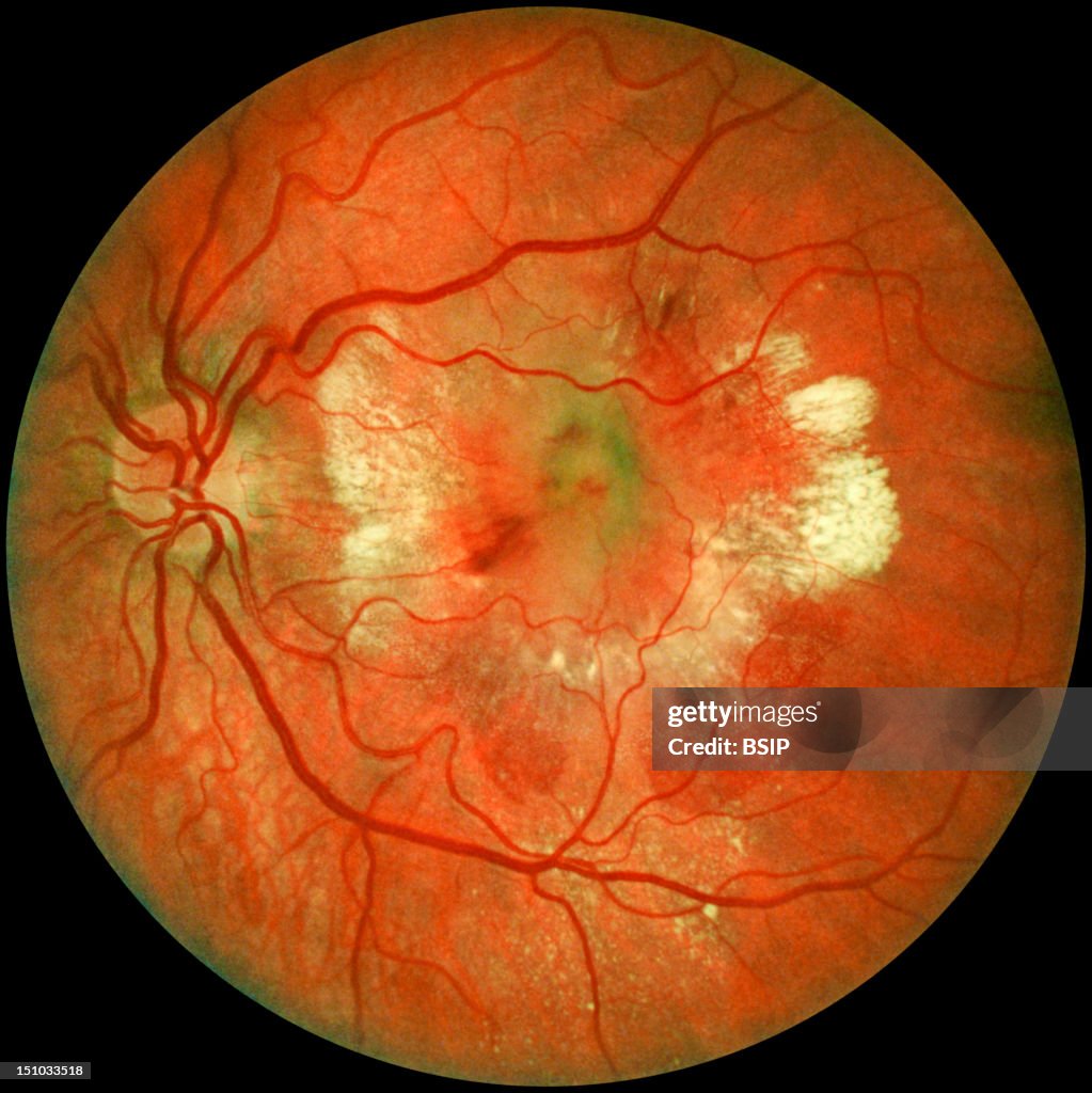 Colpite Macular Age Related Macular Degeneration, Also Called Senile Macular... News ...