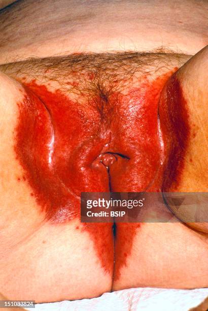 Vulvar Candidiasis In A Patient Suffering From Diabetes.