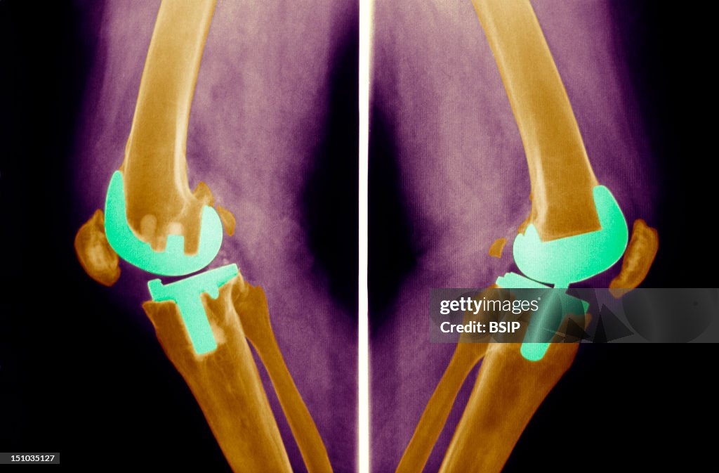 Knee Prosthesis, X-Ray