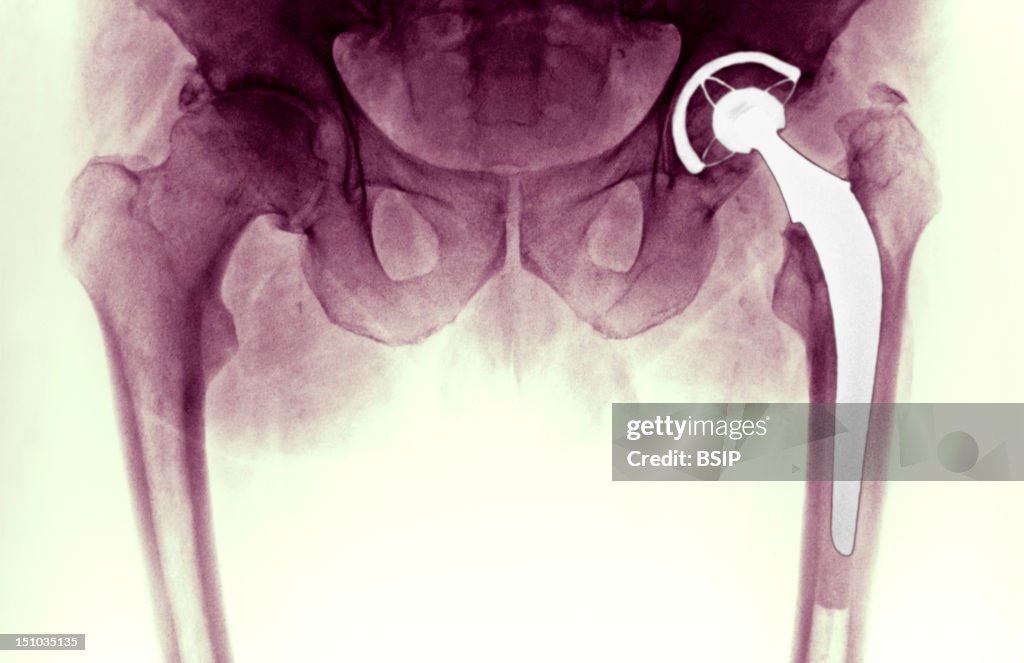 Hip Prosthesis, X-Ray