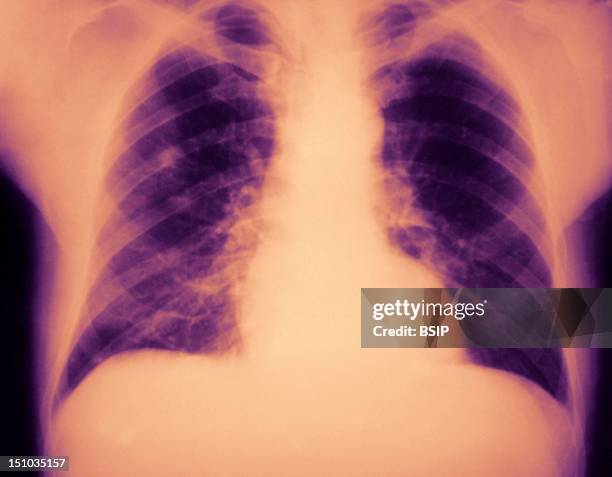 This Anteroposterior Chest X Ray Revealed Right Upper Lobe Pneumonia The Etiology Of Which Was Unknown. Pneumonia Can Be Caused By A Variety Of...
