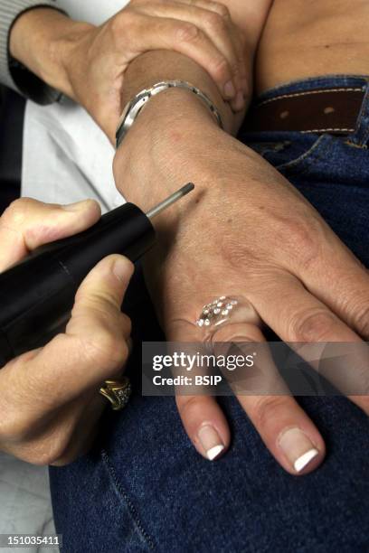 Dermatologist Removes Dark Spots On The Backside Of Hand.