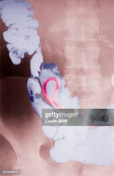 Intestinal Helminthiasis: Ascariasis. The Ascaris Is Sharply Set Off By The Contrast Substance.