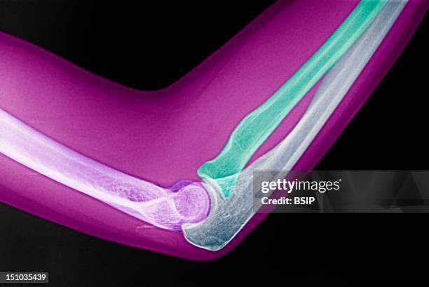 Acf Arm Antecubital Fossa Photos and Premium High Res Pictures - Getty Images