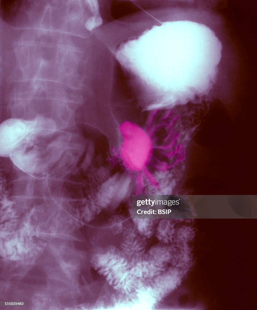 Gastric Ulcer, X-Ray