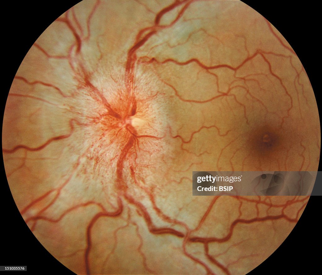 Papilledema