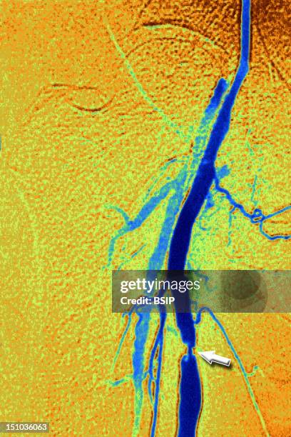 Stenosis Of Right Femoral Artery Due To Arterial Atheroma. Angiography Of Femoral Artery.