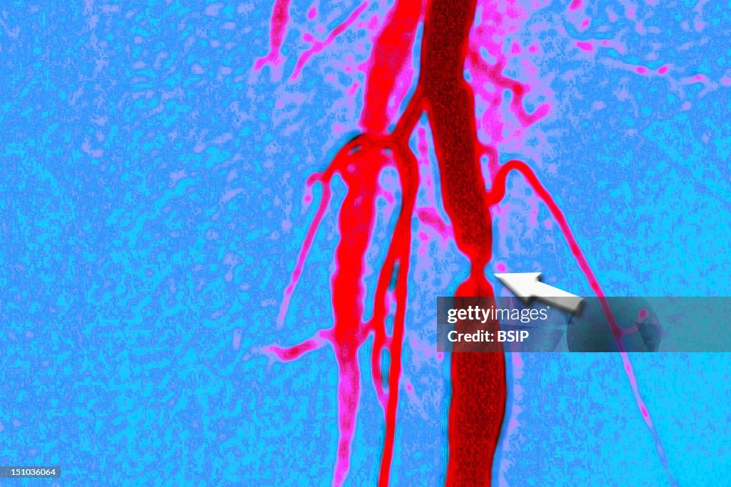 Stenosis, Femoral Artery, Angio.