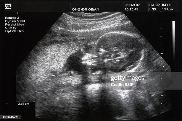 Sagittal View. 22 Week Old Fetus. Eye Sockets Are Visible.