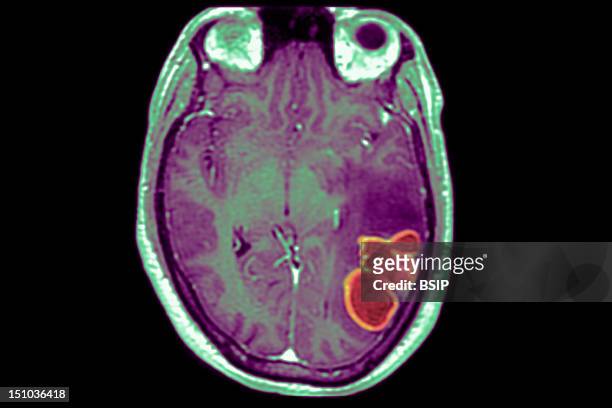 In The Temporo Occipital Region Of The Brain That Controls Language, An Abcess Causing Epileptic Seizures And Several Hours Of Aphasia Is Visible....
