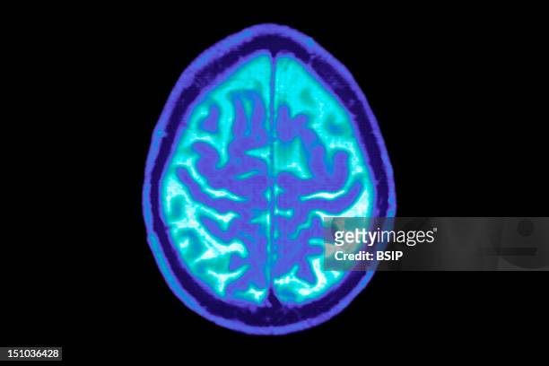 Late Onset Alzheimer's Disease Senile Dementia. Symmetric Enlargement Of Cerebral Sulci Suggests That Cortical Gray Matter Is Affected. Axial Cut...