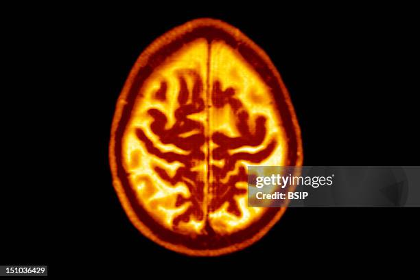 Late Onset Alzheimer's Disease Senile Dementia. Symmetric Enlargement Of Cerebral Sulci Suggests That Cortical Gray Matter Is Affected. Axial Cut...