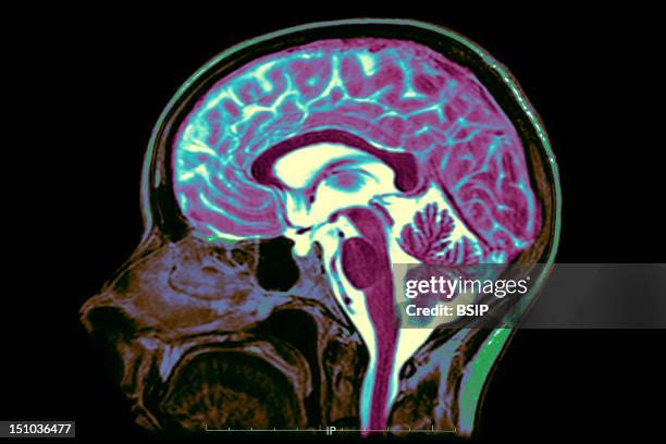 Mri T2 Of A Normal Brain. Mid Sagittal View.