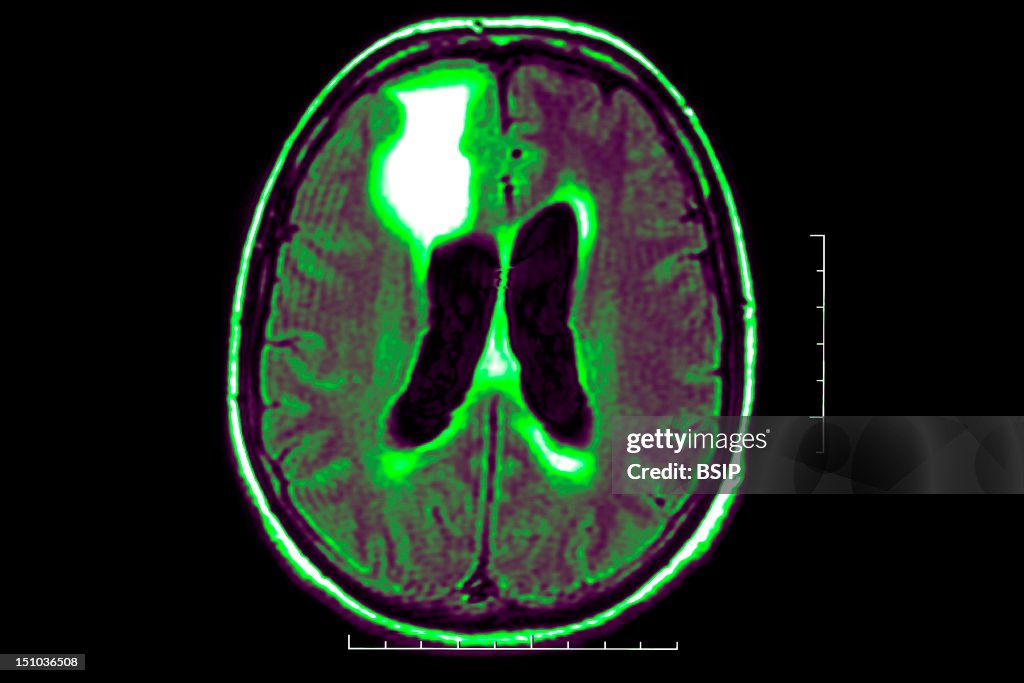 Epilepsy, Mri