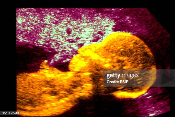 Week Old Fetus. Sagittal View. Open Mouth Is Visible.