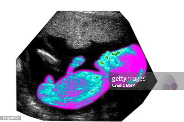 Sagittal View. 22 Week Old Fetus.