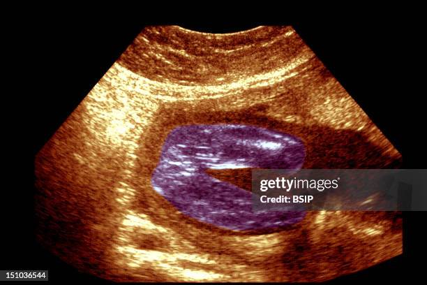 Week Old Fetus. Ultrasound Shows That Fetus Is Female The Vaginal Labia Are Visible.