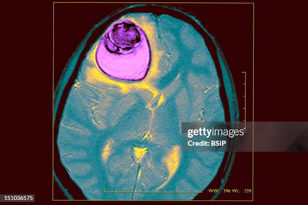 Cyst Causing Epileptic Seizures. Mri T2.