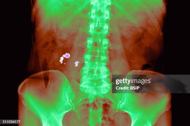 Lithiasis Renal Calculi Photos and Premium High Res Pictures - Getty Images
