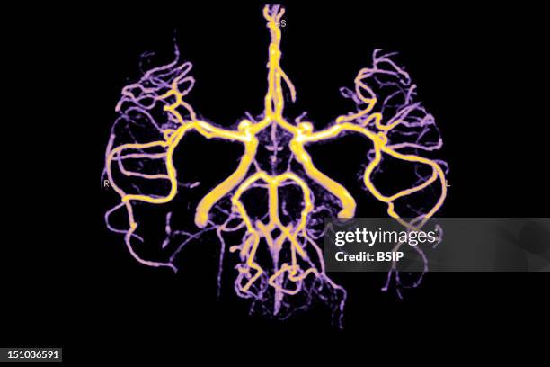 The Circle Of Willis Is A Circle Of Arteries Roughly Pentagonal In Outline At The Base Of The Brain Which Distributes Blood To The Principle Arteries...