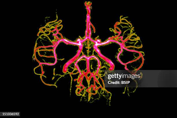 The Circle Of Willis Is A Circle Of Arteries Roughly Pentagonal In Outline At The Base Of The Brain Which Distributes Blood To The Principle Arteries...