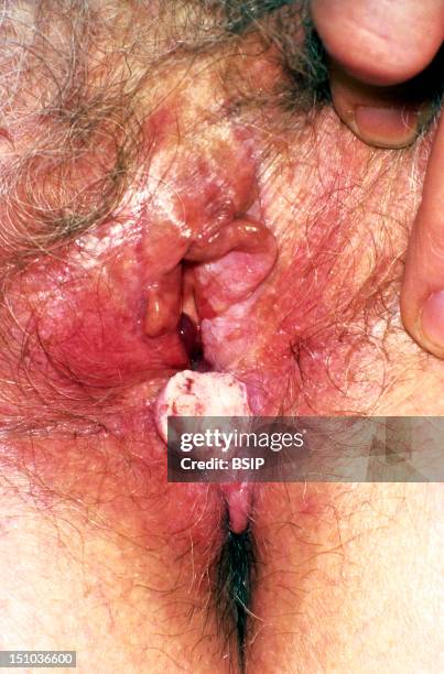 Squamous Cell Carcinoma Of The Vulva. 84 Year Old Patient.