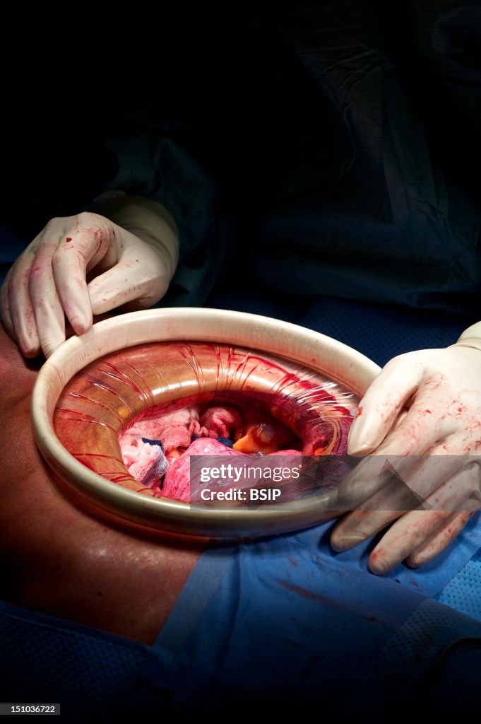 Myomectomy
