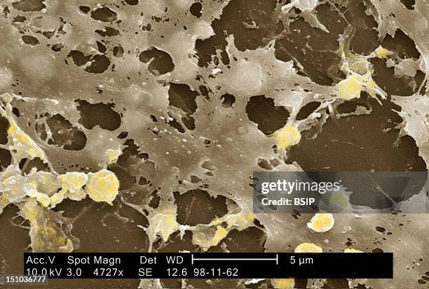 Staphylococcus Aureus In Biofilm, Coming From The Inside Of A Permanent Urinary Catheter Colorized Sem, X 4 727, The Bar Represents 5 Microns. A...